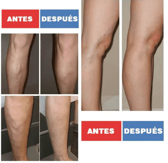 48 Parches para tratamiento de varices